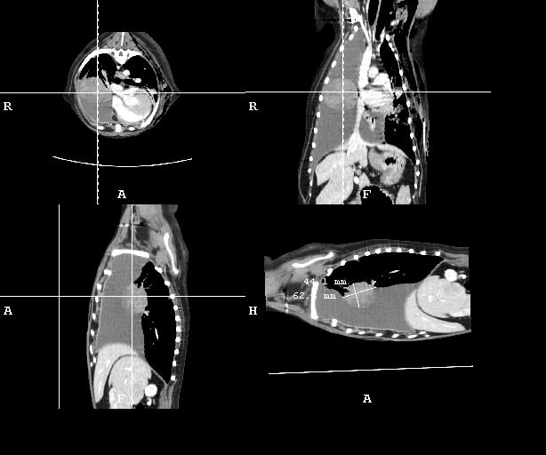 Scanner thoracique d'une tumeur pulmonaire avec épanchement pleural et pneumothorax