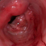 Mastocytome du colon chez un chat
